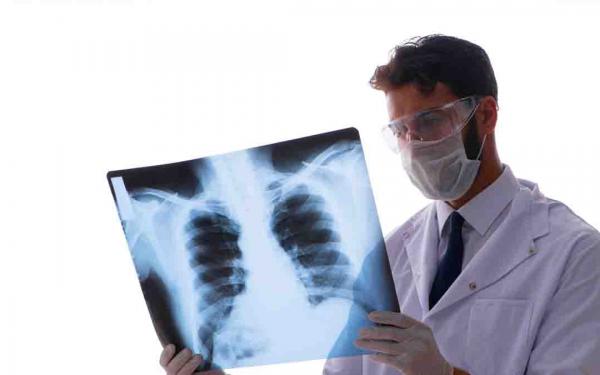 QUE ES UN DERRAME PLEURAL