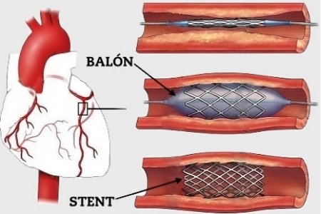 ANGIOPLASTIA PERCUTANEA CORONARIA