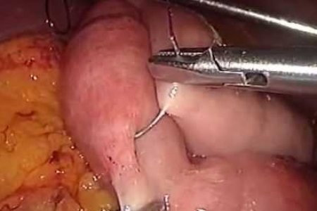 CIRUGIA ANTIRREFLUJO 