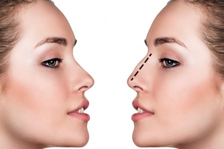 CIRUGIA ESTÉTICA Y FUNCIONAL DE NARIZ