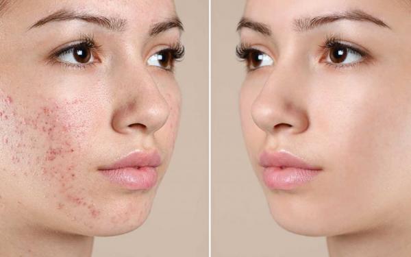 TRATAMIENTOS PARA EL ACNE
