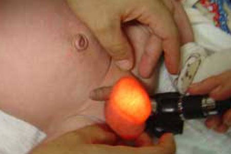 ALTERACIONES DE DESCENSO TESTICULAR