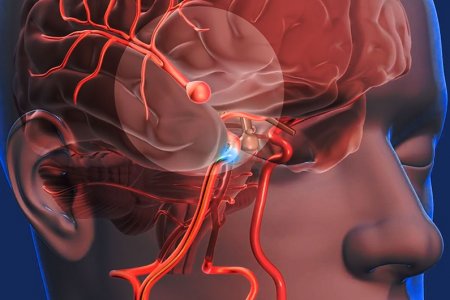 ANEURISMA CEREBRAL