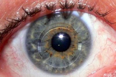 CIRUGIA DE QUERATOCONO