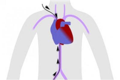 CATETERISMO CARDIACO DIAGNOSTICO