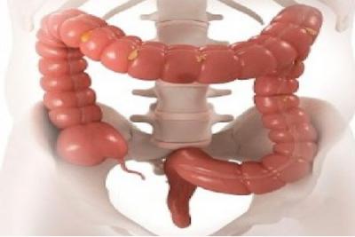 CIRUGIA COLORECTAL