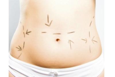 DERMOLIPECTOMIA ABDOMINAL