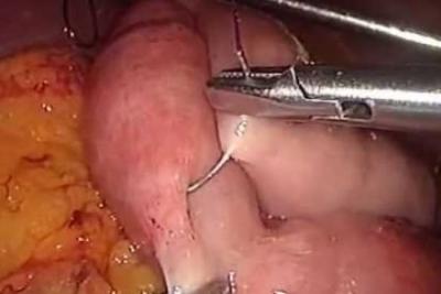 CIRUGIA ANTIRREFLUJO 