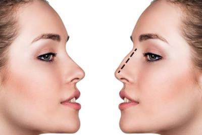 CIRUGIA ESTÉTICA Y FUNCIONAL DE NARIZ