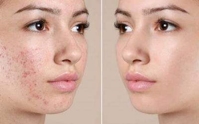 TRATAMIENTOS PARA EL ACNE