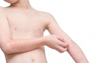 URTICARIA CRÓNICA